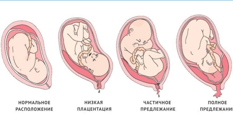 Typer placenta previa