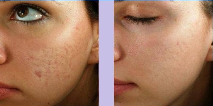Kvinnens ansikt før og etter massasje