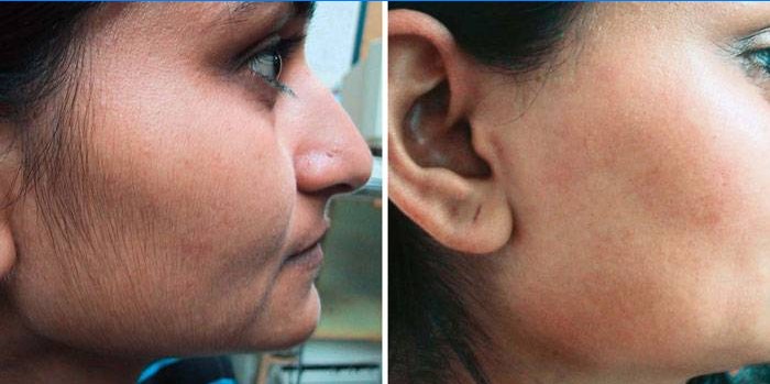 Laserhårfjerning i ansiktet: før og etter bilder